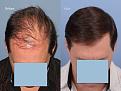 Dr. Paul Shapiro, MD
FUT 4365 grafts
12 months post-op