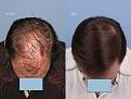 Dr. Paul Shapiro, MD
FUT 4365 grafts
12 months post-op