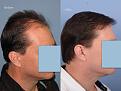 Dr. Paul Shapiro, MD
FUT 4365 grafts
12 months post-op