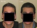 Paul Shapiro, MD
FUT 2619 grafts
12 months post-op