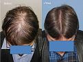 Paul Shapiro, MD
FUT 3380 grafts
12 months post-op