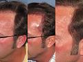 Dr. Paul Shapiro, MD
FUT 2103 grafts
 12 months post op