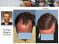 Dr. Paul Shapiro, MD
FUT 2103 grafts
 12 months post op