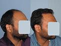 Dr. Paul Shapiro, MD
FUT 4138 grafts
12 months post-op