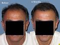 Dr. Paul Shapiro, MD
FUT 2915 grafts
6months post-op