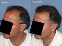 Dr. Paul Shapiro, MD
FUT 2915 grafts
6 months post-op