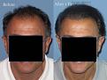 Dr. Paul Shapiro, MD
FUT 2915 grafts
12 months post-op