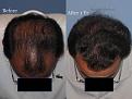 Dr. Paul Shapiro, MD
FUT 2915 grafts
12 months post-op