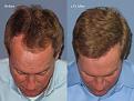 Dr. Paul Shapiro, MD
FUT 2125 grafts
12 months post-op