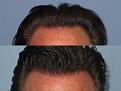 Dr. Paul Shapiro, MD
FUT  1913 grafts
6 months post-op