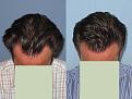 Dr. Paul Shapiro, MD
FUT  1913 grafts
6 months post-op