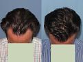 Dr. Paul Shapiro, MD
FUT  1913 grafts
6 months post-op