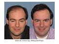 Dr. Paul Shapiro, MD
FUT
4000 grafts/8274 hairs
12 months post-op