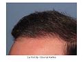 Dr. Paul Shapiro, MD
FUT
4000 grafts/8274 hairs
12 months post-op