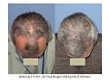 Dr. Paul Shapiro, MD 
FUT
2693 grafts/5193 hairs
12 months post-op