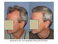 Dr. Paul Shapiro, MD 
FUT
2693 grafts/5193 hairs
12 months post-op