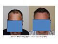 Dr. Paul Shapiro, MD 
FUT 
5207 grafts/ 11,661 hairs
3 surgical sessions
12 months post-op session 3