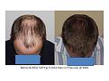 Dr. Paul Shapiro, MD 
FUT 
5207 grafts/ 11,661 hairs
3 surgical sessions
12 months post-op session 3