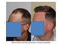 Dr. Paul Shapiro, MD 
FUT 
5207 grafts/ 11,661 hairs
3 surgical sessions
12 months post-op session 3