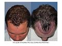 Dr. Paul Shapiro, MD 
FUT
2164 grafts/ 4395 hairs
12 months post-op