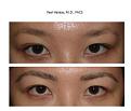 eyebrow before and after