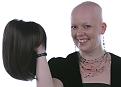 alopecia