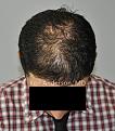 BEFORE Anderson Center for Hair Restoration Transplant