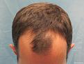 Before Hair Transplant - Top View