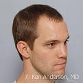 Dr. Ken Anderson - 32 year old Norwood 3 - ARTAS and PRP with ACell - 14 month post-procedure results