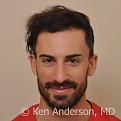 Jason Nicola	
Norwood 3
Age: 34
Surgeon: Dr. Ken Anderson, MD
Location: Atlanta, Georgia
	
Clinical History:
Jasons initial consultation with me was back in February of 2015 at the age of 33.  His friend had an ARTAS procedure with me in 2013 and was thrilled with the results, so he referred his friend Jason to the Anderson Center for Hair for evaluation and treatment.  Jason told me at our initial consultation that his hair loss made him look older than he felt on the inside. He said that his hair