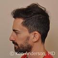 Jason Nicola	
Norwood 3
Age: 34
Surgeon: Dr. Ken Anderson, MD
Location: Atlanta, Georgia
	
Clinical History:
Jasons initial consultation with me was back in February of 2015 at the age of 33.  His friend had an ARTAS procedure with me in 2013 and was thrilled with the results, so he referred his friend Jason to the Anderson Center for Hair for evaluation and treatment.  Jason told me at our initial consultation that his hair loss made him look older than he felt on the inside. He said that his hair