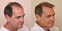 57 year old man who had an ARTAS Robotic Hair Transplant by Dr. Ken Anderson, at the Anderson Center for Hair in Atlanta, Georgia.
