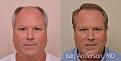 Linear Strip Hair Transplant Results at 6 months - Anderson Center for Hair