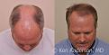 Linear Strip Hair Transplant Results at 6 months - Anderson Center for Hair