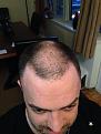 Before Hair Transplant and Kermax