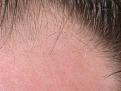 New Hairs 3 months zoom2