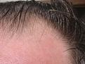 New Hairs 3 months zoom1