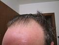 New Hairs 3 months