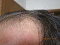 New Hairs 4 Months.