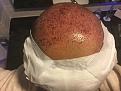 2 hours after transplant
