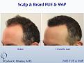 Repairing a Wronged Patient with FUE & SMP