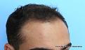 Right Side View 6 Months After Hair Transplant
