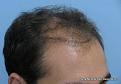 Right Side View Before Hair Transplant