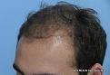 Left Side View Before Hair Transplant