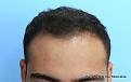 Front View 6 Months After Hair Transplant
