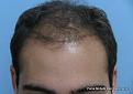 Front View Before Hair Transplant