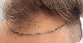 edmonton hair transplant before photo