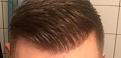 edmonton hair transplant after photo