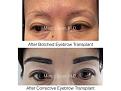 corrective eyebrow transplant