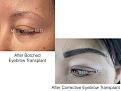corrective eyebrow transplant